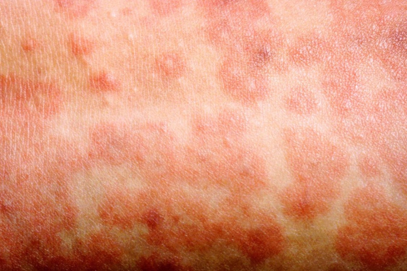 Measles Outbreak Raises Alarm Across England Following Child's Death