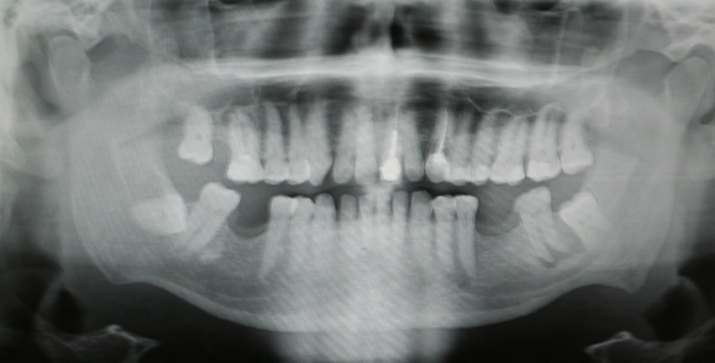 Southport sees 25% rise in the number of NHS dentists leaving as Lib Dems announce £750 million package