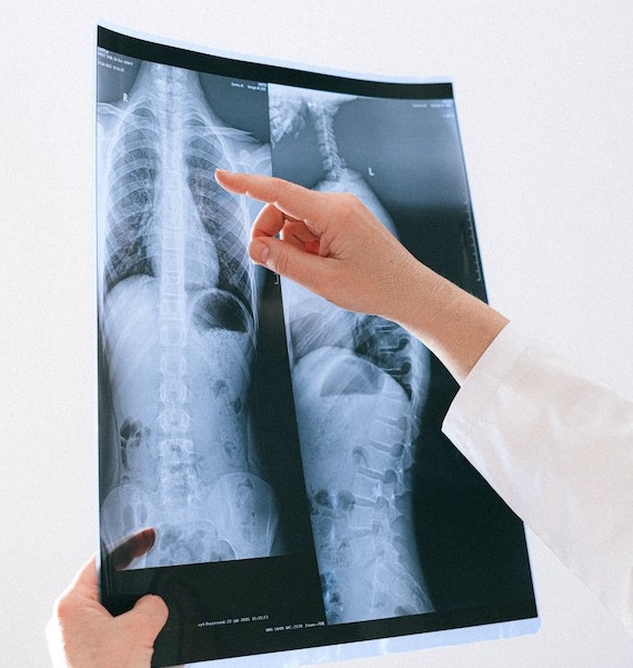 New Lung Cancer Screening roll out to detect cancer sooner